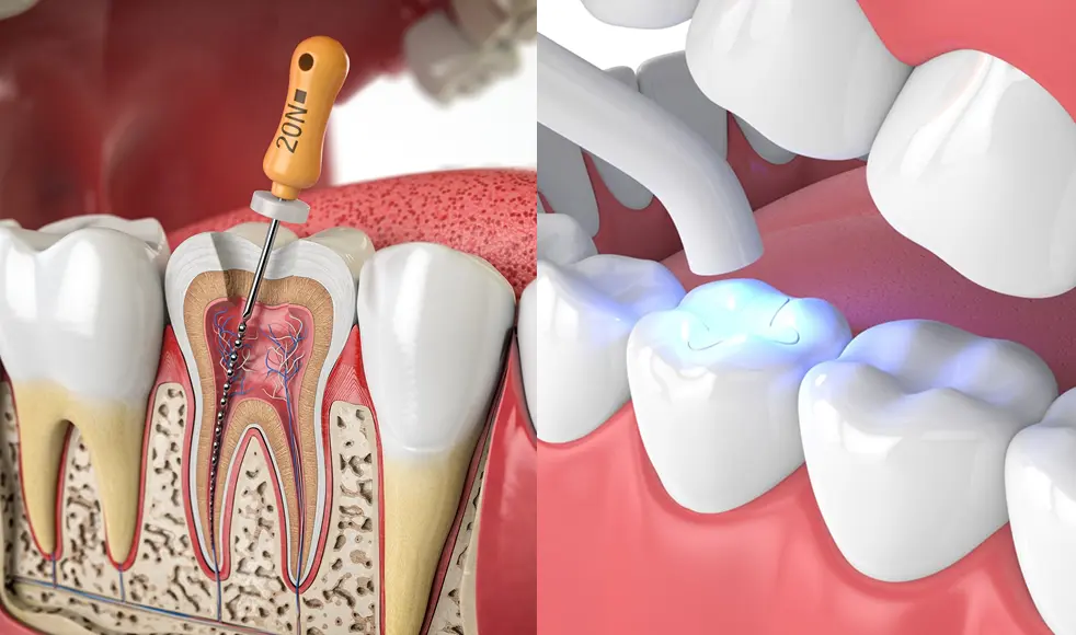 endodontie et traitement des caries